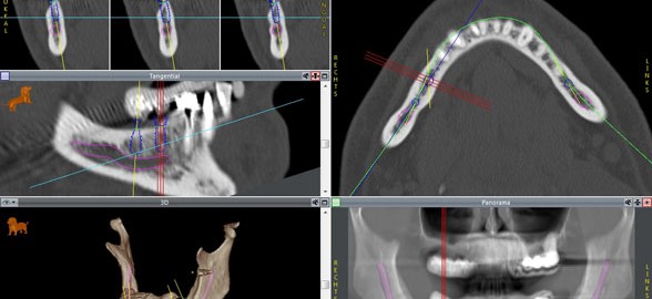 Implantatplanung