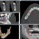 Implantatplanung