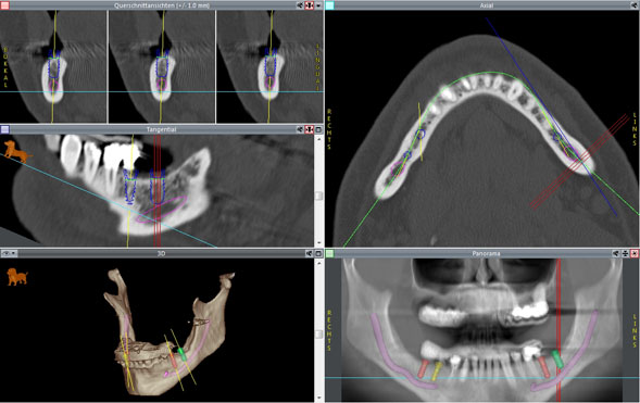 Implantatplanung