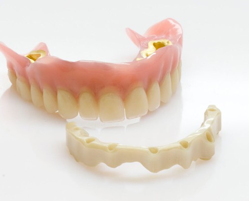 Zirkonsteg auf sieben Implantaten