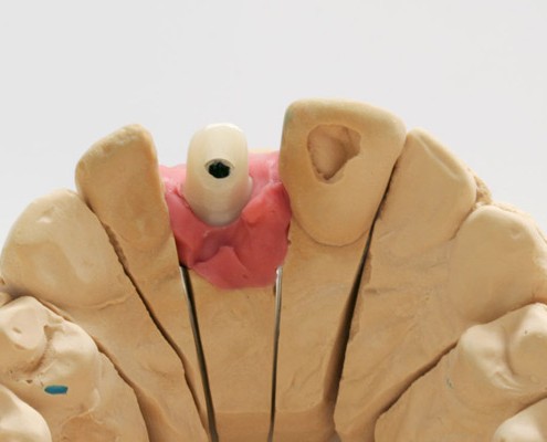 Implantatversorgung, Zirkonabutment