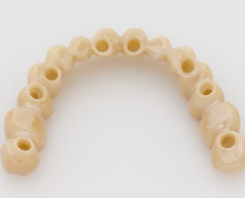 Implantatgetragene Brücke aus Zirkon