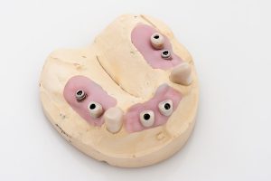 Teleskoparbeit auf Implantaten