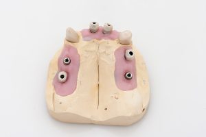 Teleskoparbeit auf Implantaten