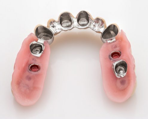 Teleskoparbeit auf Implantaten