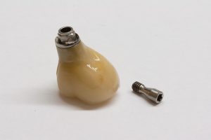 Verschraubte Zirkonkrone auf Implantat