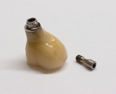 Verschraubte Zirkonkrone auf Implantat