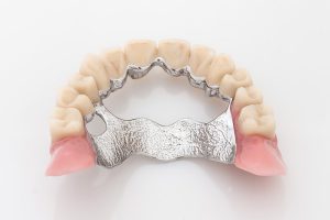 OK Teleskoparbeit mit Implantaten