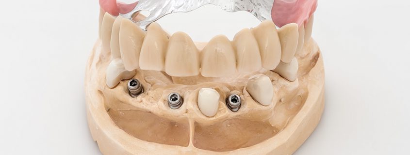 OK Teleskoparbeit mit Implantaten