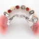 OK Teleskoparbeit mit Implantaten