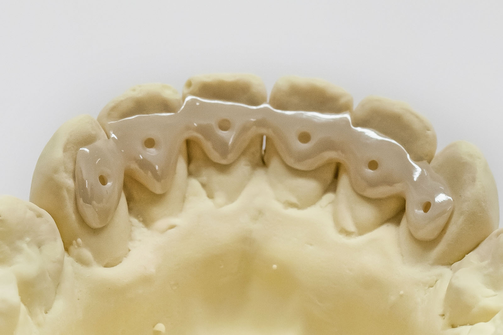 Retainer im Oberkiefer