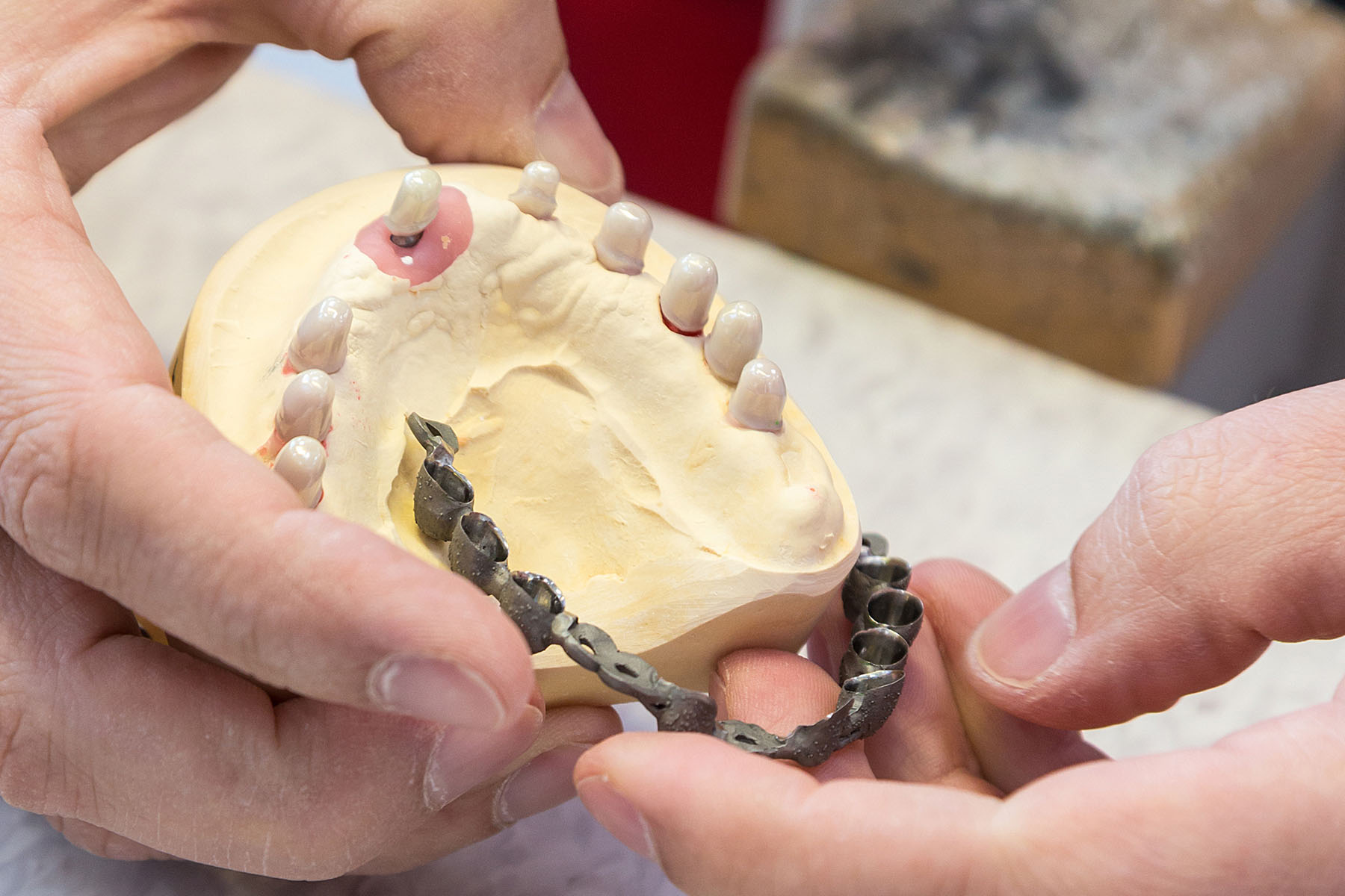Prüfen der Passung des gegossenen Grundgerüstes für eine Implantatprothese im Oberkiefer.